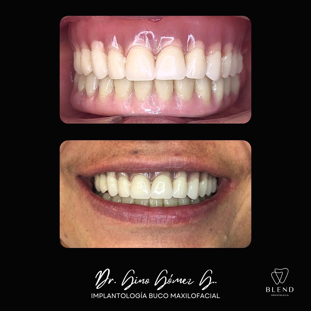 Pinze Per Estrazione Dentale No.150S Per Bambini, Modello - Foto 10