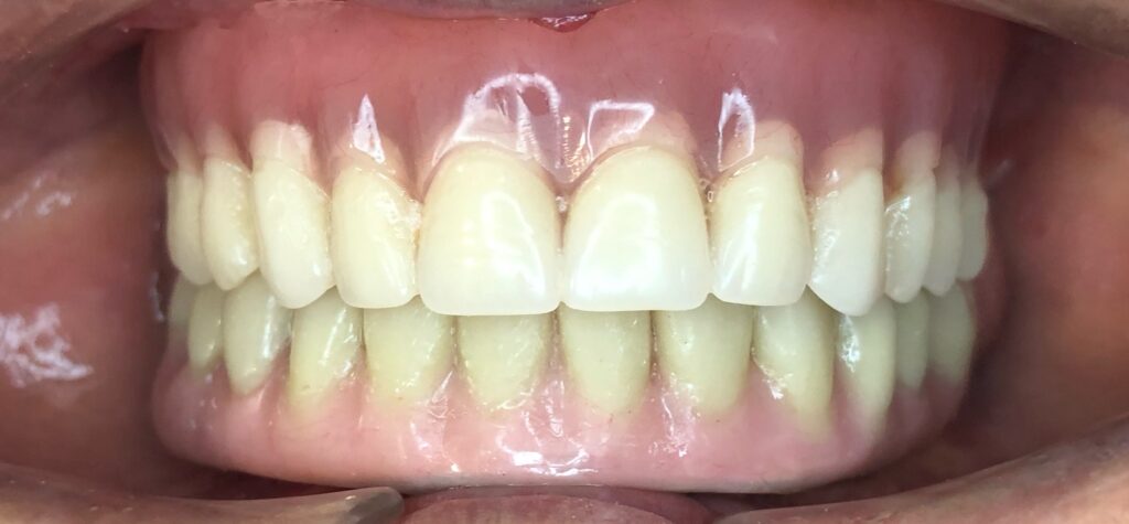 Prótesis de arco completo sobre implantes 1 4