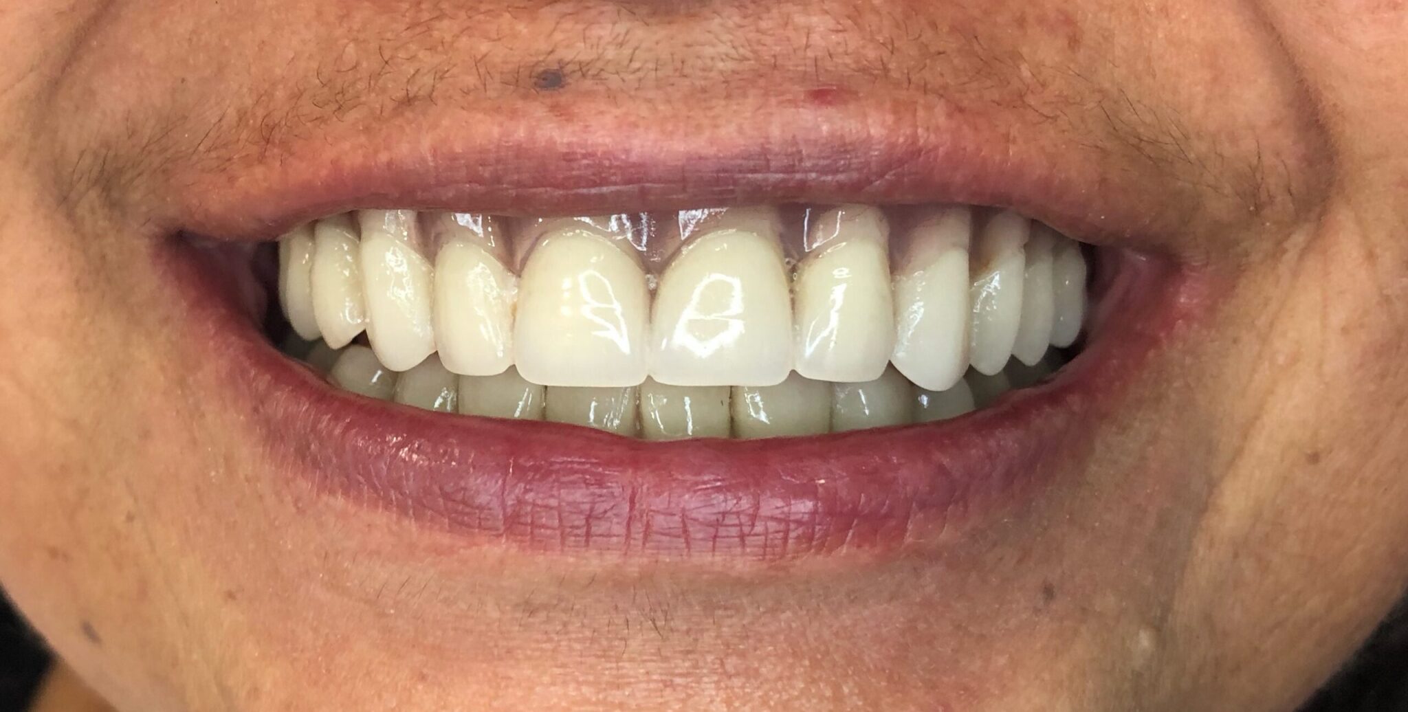Prótesis de arco completo sobre implantes 2 5 scaled