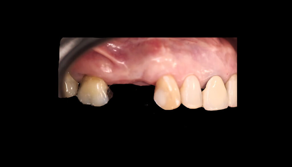 Prótesis fija sobre implante dental 3 RRSS 1