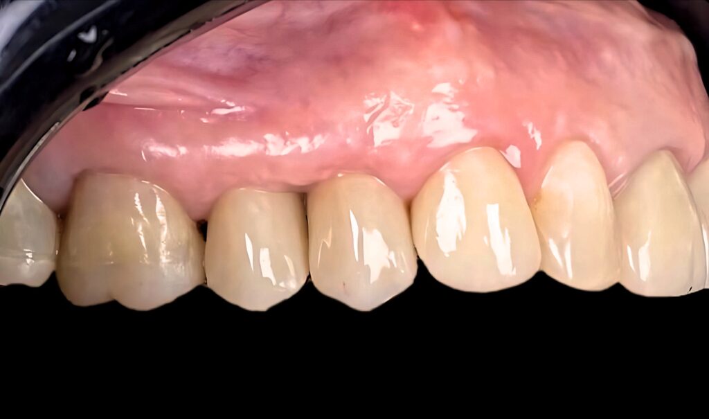 Prótesis fija sobre implante dental 2 RRSS 2