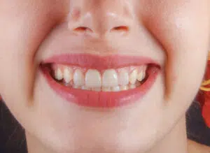 Blanqueamiento Dental Clínico