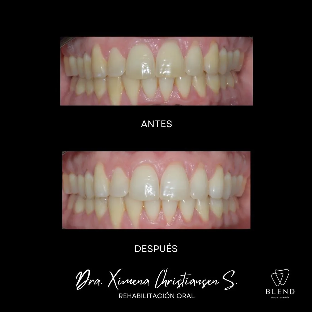 Tratamiento Blanqueamiento Dental