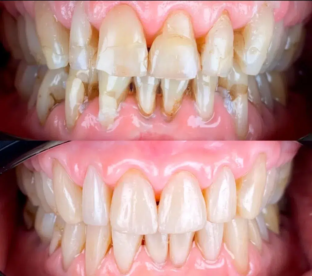 carillas directas 1 web